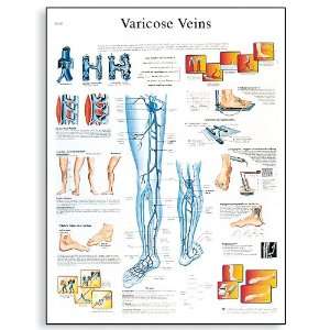 3B Scientific VR1367UU Glossy Paper Varicose Veins Anatomical Chart 
