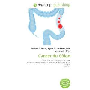  Cancer du Côlon (French Edition) (9786132911612) Books