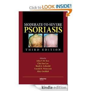 Moderate to Severe Psoriasis John Y. M. Koo, Chai Sue Lee, Mark G 