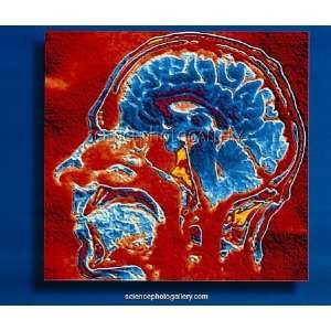  Coloured CT scan of the brain in head (side view) Canvas 